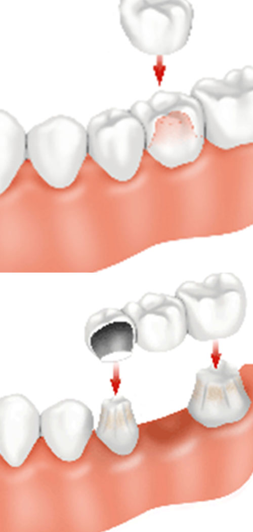 crowns-and-bridges