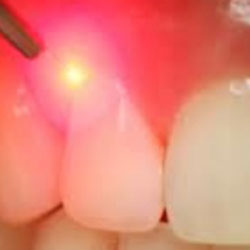 Laser Gum Contouring laser