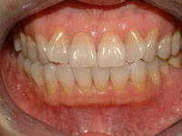 Before