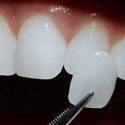Veneers veneers